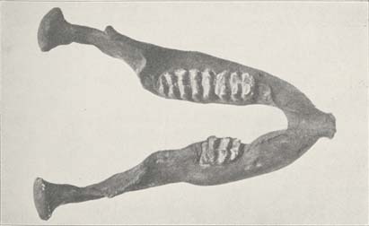 The Cohoes Mastodon Deformed Lower Jaw in New York State Museum.